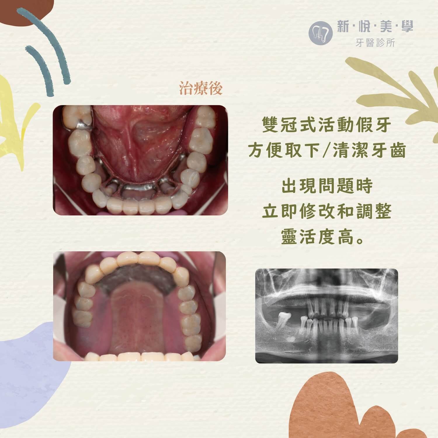 里長伯 牙齒重生！ 工作不「滴累」 的第2張圖片